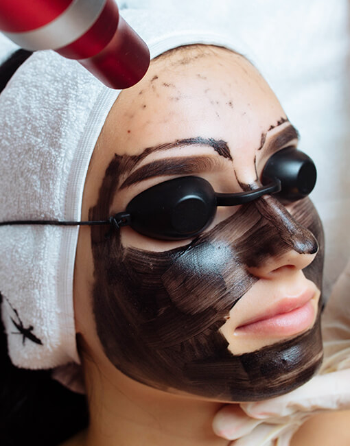 Carbon peeling, lézeres arckezelés, mélytisztító, pórusösszehúzó, bőrmegújító, YAG lézer, Turi Szilvia, Győr, x-Shape stúdió, kozmetika